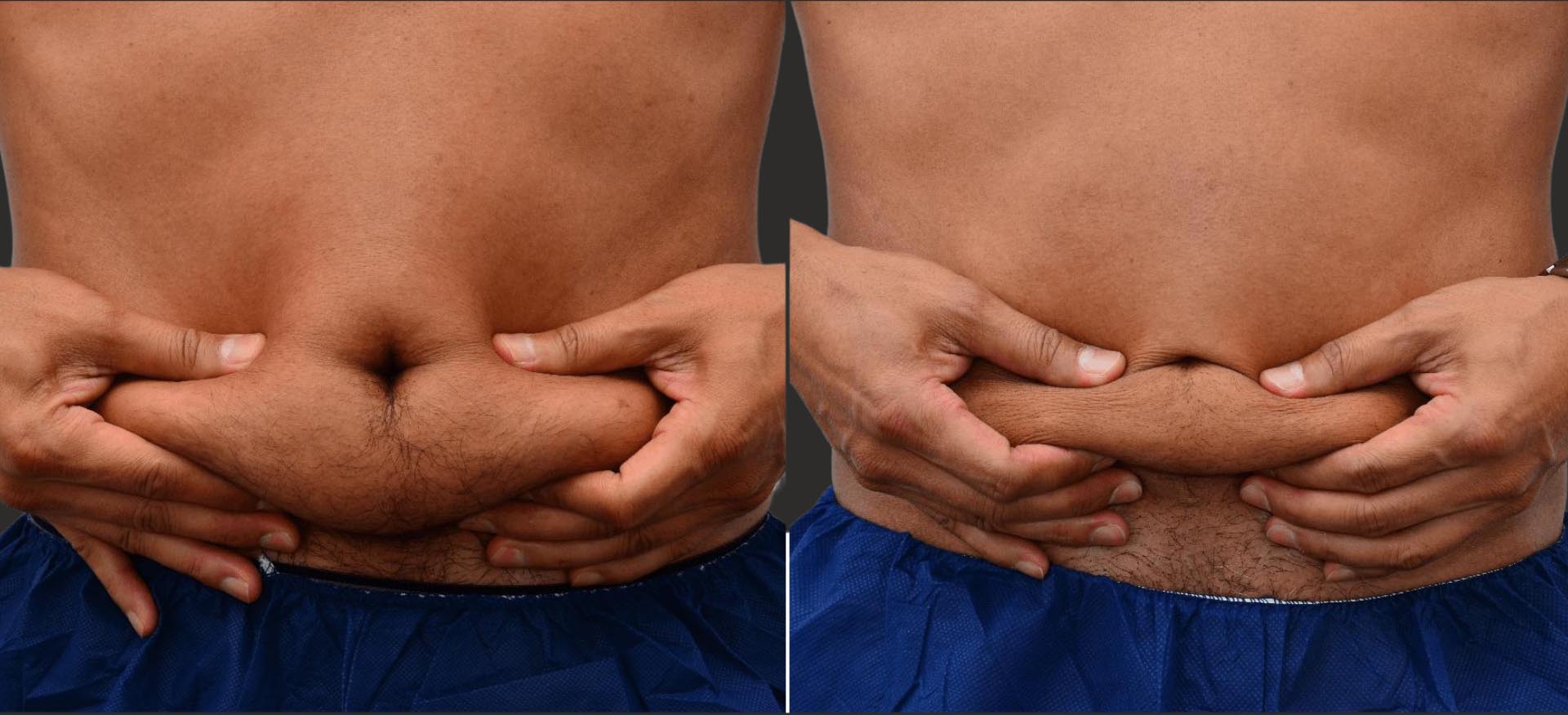 Before and after results of significant fat reduction in the lower abdomen of 35 year old male after 2 sessions of cryolipolysis.