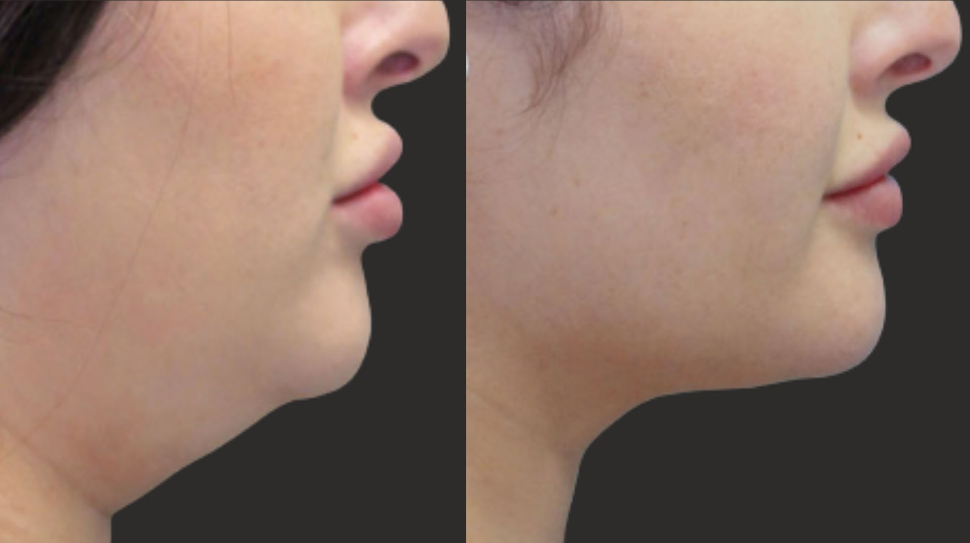 Before and after results of double chin reduction of 32 year old female after 3 sessions of cryolipolysis.