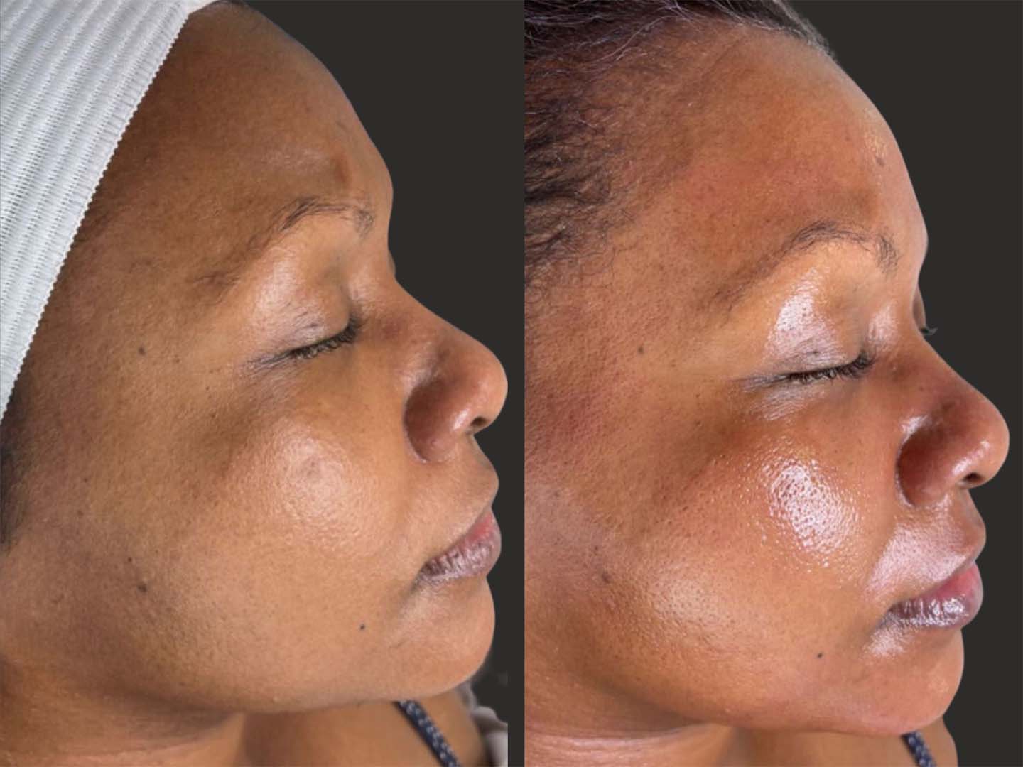 Before and after results of 50 year old female after 1 hydra session, with more hydrated and smoother skin quality and texture.