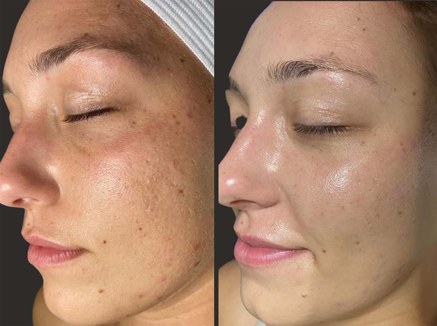 Before and after results of 29 year old female after 1 hydra session, with smoother, more hydrated skin and refined pore size.