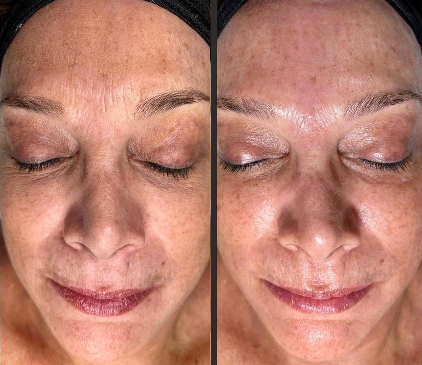 Before and after results of 57 year old female after 2 hydra sessions with more hydrated and smoother skin quality and texture