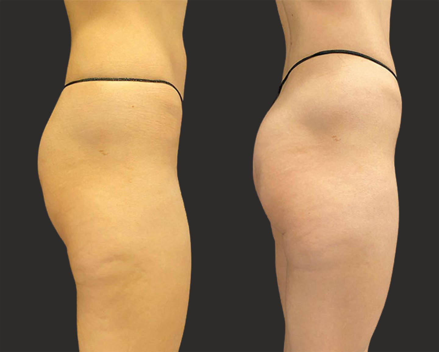 Before and after results of 38 year old female’s buttocks 2 weeks after 6 MSculpt sessions.