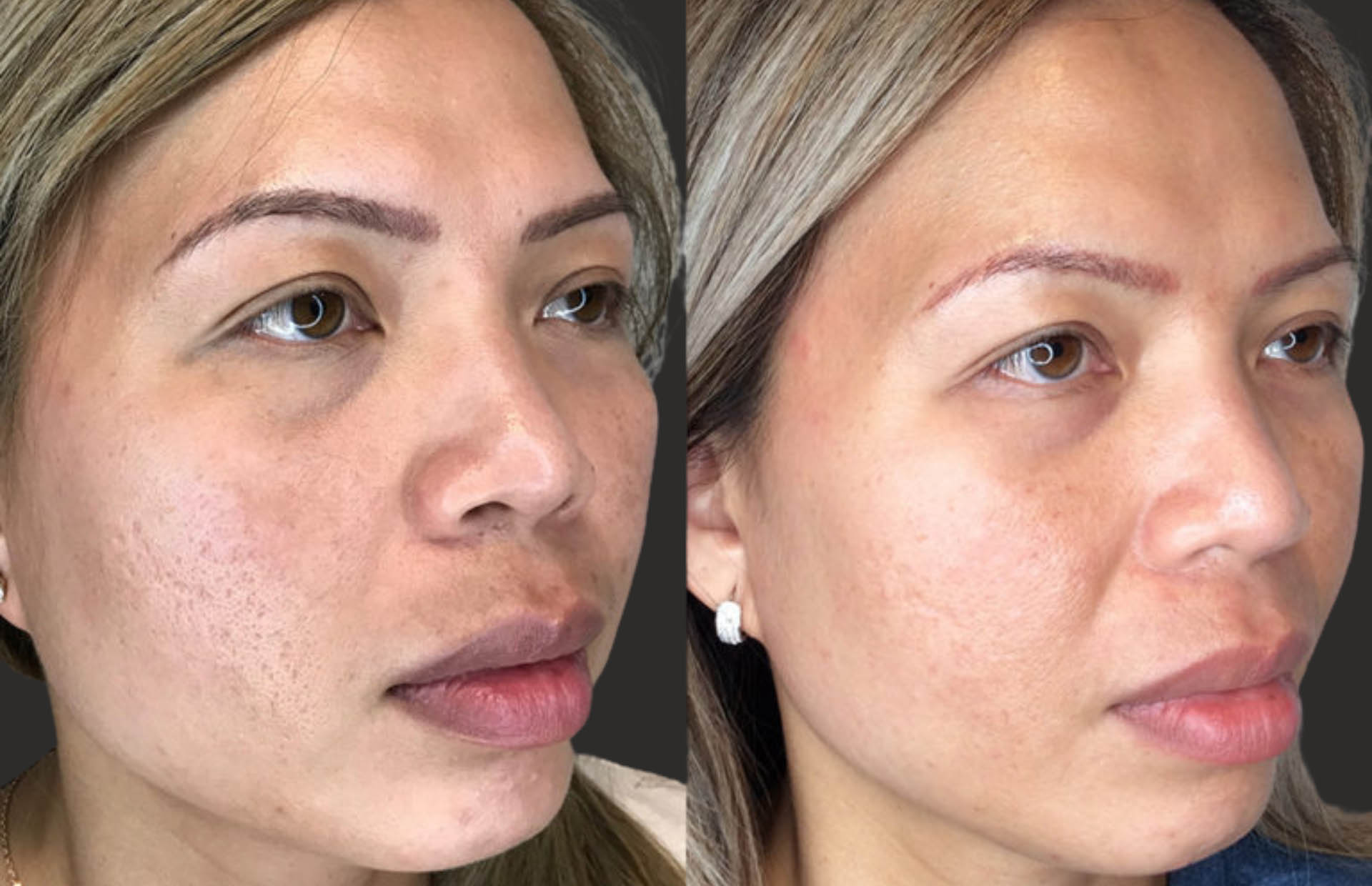 Before and after results of improved texture and tone and reduced atrophic acne scarring after one RF microneedling treatment.